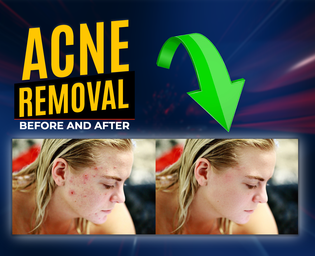 Acne Removal Photo Retouching
